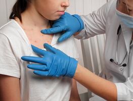 Misteriosa viruela de Alaska alerta a las autoridades; esto es lo que sabe sobre el mortal virus