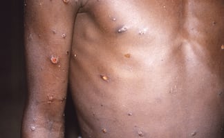 Viruela del mono. OMS analizará la próxima semana si eleva alerta sanitaria