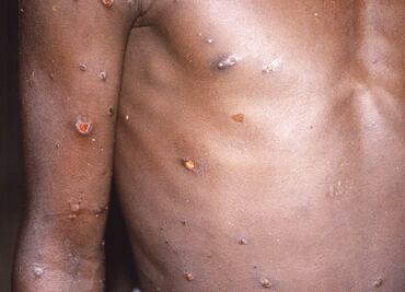 Viruela del mono. OMS analizará la próxima semana si eleva alerta sanitaria