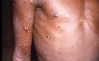 Viruela del mono. Los antivirales que reducirían la duración de síntomas