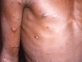 Viruela del mono. Los antivirales que reducirían la duración de síntomas