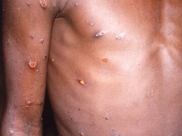 Viruela del mono. Los antivirales que reducirían la duración de síntomas