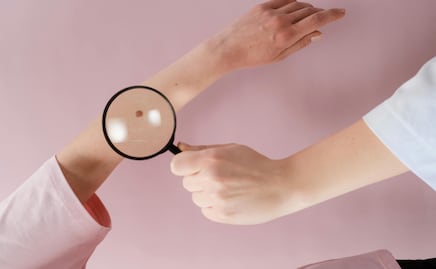 ¿Melanoma y cáncer de piel son lo mismo? Aprende a diferenciarlos y cómo prevenirlos
