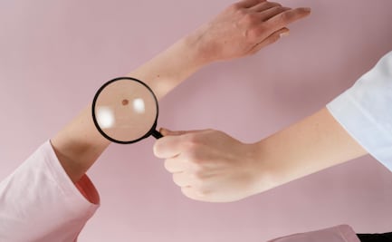 ¿Melanoma y cáncer de piel son lo mismo? Aprende a diferenciarlos y cómo prevenirlos