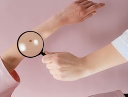 ¿Melanoma y cáncer de piel son lo mismo? Aprende a diferenciarlos y cómo prevenirlos