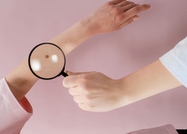 ¿Melanoma y cáncer de piel son lo mismo? Aprende a diferenciarlos y cómo prevenirlos