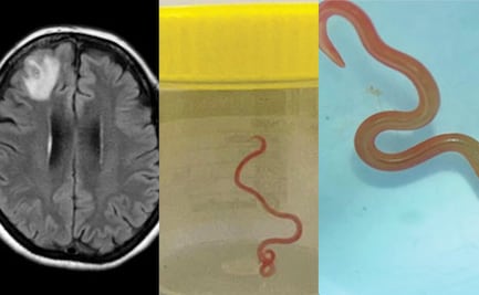 Médicos extraen un gusano vivo del cerebro de una mujer; el primer caso en humanos