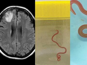Médicos extraen un gusano vivo del cerebro de una mujer; el primer caso en humanos