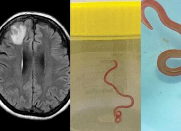 Médicos extraen un gusano vivo del cerebro de una mujer; el primer caso en humanos