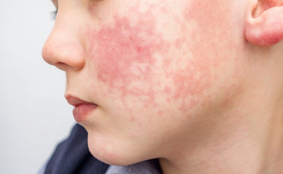 Aumentan casos del "Virus de la bofetada". Qué es, cómo se contagia y síntomas. Foto: iStock / Evgen_Prozhyrko