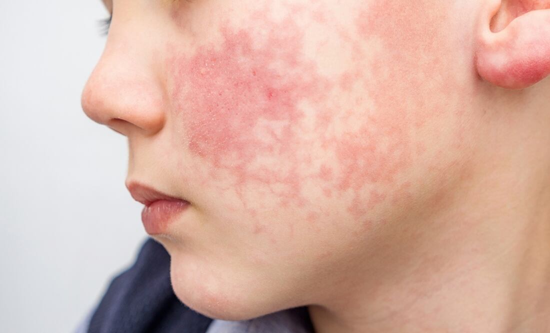 Aumentan casos del "Virus de la bofetada". Qué es, cómo se contagia y síntomas. Foto: iStock / Evgen_Prozhyrko