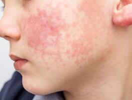 Aumentan casos del "Virus de la bofetada". Qué es, cómo se contagia y síntomas