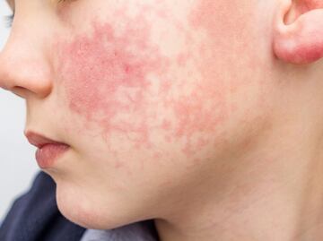 Aumentan casos del "Virus de la bofetada". Qué es, cómo se contagia y síntomas