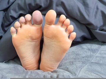 ¿Cuáles son las etapas del pie diabético? ¿Cómo comienza?