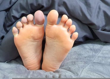 ¿Cuáles son las etapas del pie diabético? ¿Cómo comienza?