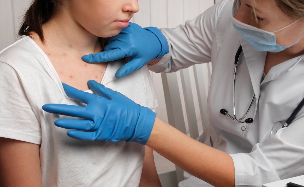 Measles Outbreak in US: 600+ Cases in 21 States