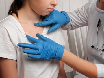 Vacuna contra Sarampión. ¿Quiénes SÍ deben vacunarse y quiénes NO deben recibir dosis? Experto explica