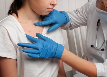 EU envía expertos a Texas para ayudar con el peor brote de sarampión en 30 años