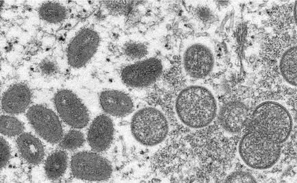 Viruela del mono. Nueva York suma mil casos, casi un tercio de todo EU