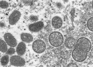 Viruela del mono. Nueva York suma mil casos, casi un tercio de todo EU