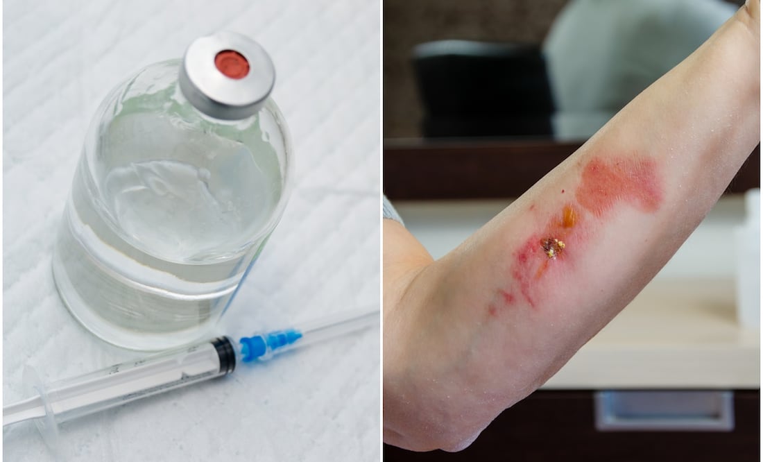 La xilazina causa pudrimiento de la carne humana y hasta la muerte. Foto: iSTOCK/Todorean Gabriel/Liudmila Chernetska