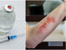 Aumentan casos de la droga "zombie" que pudre la carne; esto se sabe