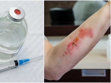 Aumentan casos de la droga "zombie" que pudre la carne; esto se sabe