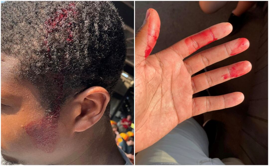 El lesionado publicó las fotos de la lesión que le causó el celular. Foto: Facebook David Carter