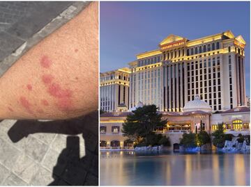 Huéspedes acusan que estos lujosos hoteles en Las Vegas tienen chinches