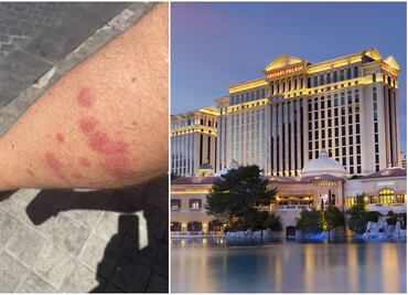 Huéspedes acusan que estos lujosos hoteles en Las Vegas tienen chinches