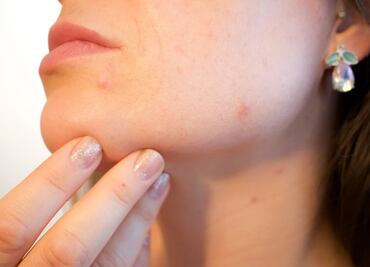 Erupciones cutáneas pueden ser síntoma de Covid-19: expertos