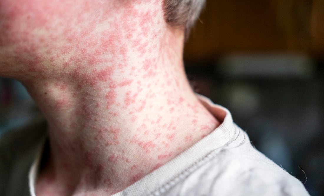 CDC recomienda a viajeros internacionales vacunarse contra el sarampión, sin importar el destino. Foto: iStock / Natalya Maisheva