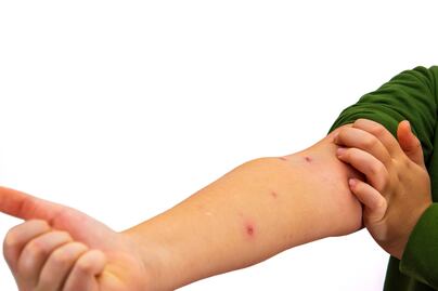 Estados Unidos registra 308 casos de sarampión en lo que va del año, supera el total de casos del 2024