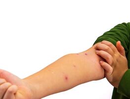 Estados Unidos registra 308 casos de sarampión en lo que va del año, supera el total de casos del 2024