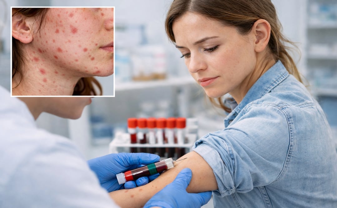 ¿Cómo saber si ya me dio sarampión? Esta es la prueba que revela si eres inmune. Foto: Especial