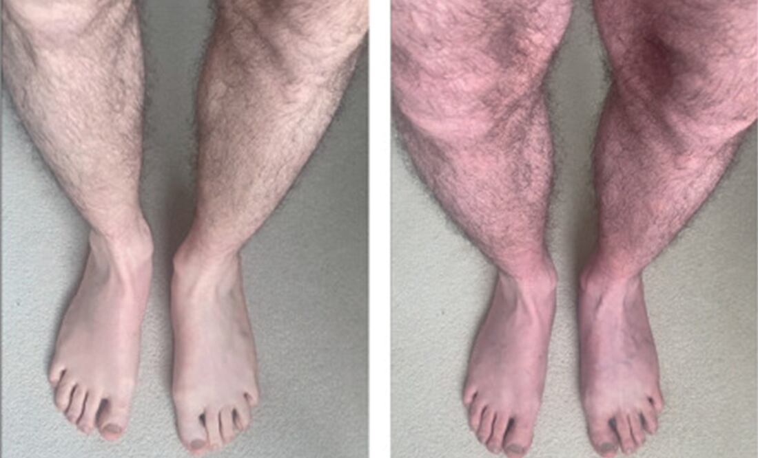 El paciente presentó un cuadro extraño luego de infectarse con Covid-19. Foto: The Lancet