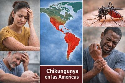 OPS alerta por aumento de casos de chikunguña en América: síntomas, contagio y zonas afectadas