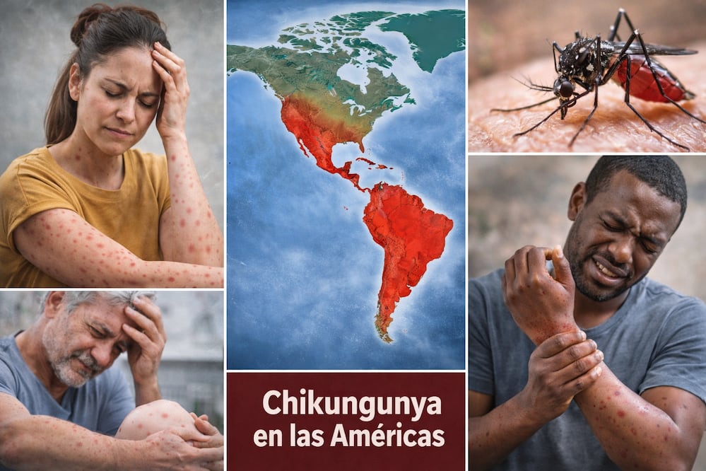 OPS alerta por aumento de casos de chikunguña en América: síntomas, contagio y zonas afectadas. Foto: IA