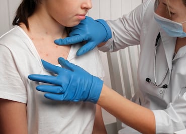 Repuntan los casos de sarampión en Texas con más de 300 contagios en 2025. ¿Qué condado tiene más casos?