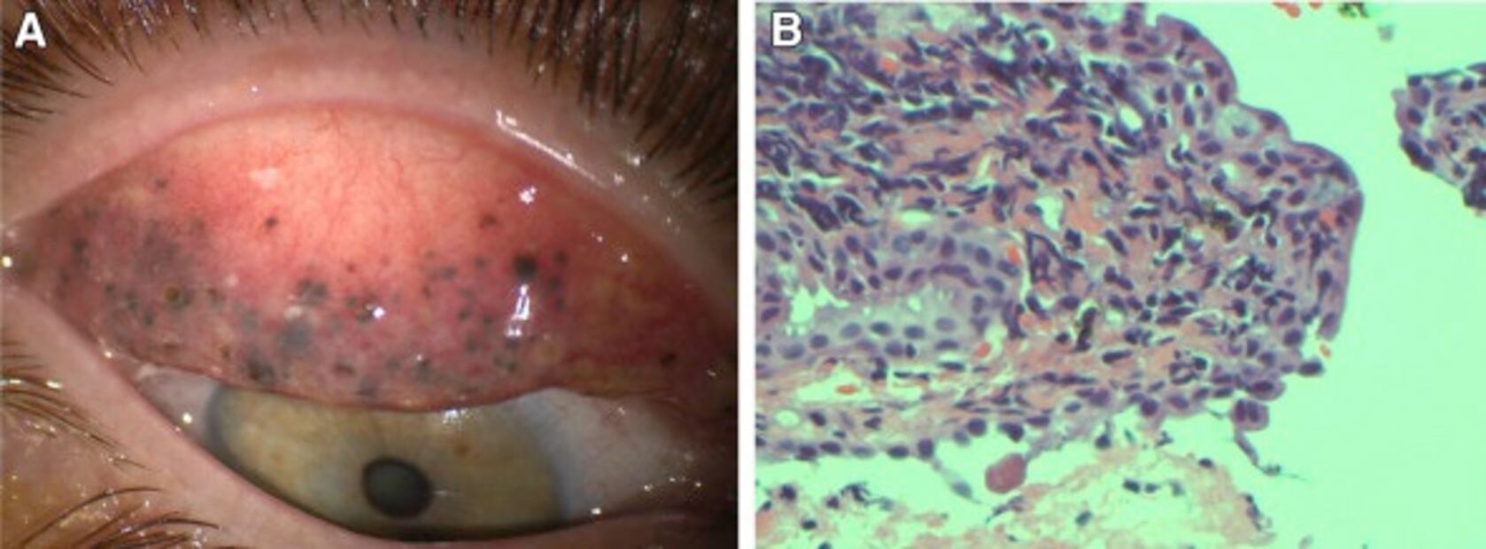 Foto: las graves consecuencias de no desmaquillarse lo ojos