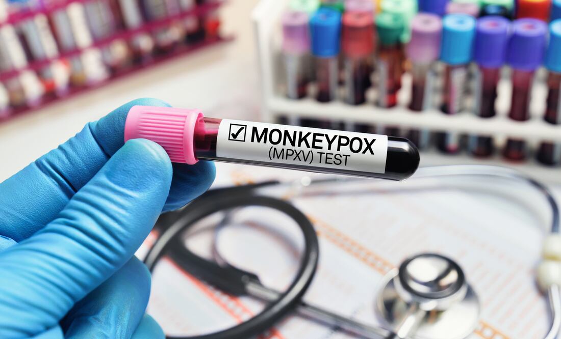 OMS alerta sobre nueva cepa mortal de mpox, viruela del mono. Foto iStock / angelp