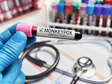 Alertan por nueva cepa del virus mpox, "viruela del mono", con potencial pandémico
