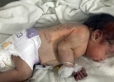 ¿Qué es la septicemia neonatal por enterovirus que afecta a recién nacidos en Francia?