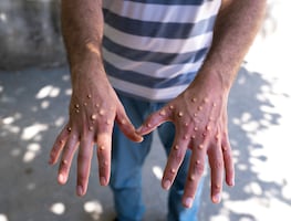 Mpox. ¿Qué es y qué síntomas desarrolla? ¿Hay vacunas disponibles?