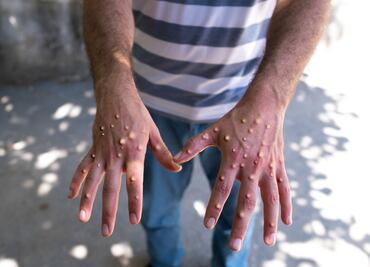 Mpox. ¿Qué es y qué síntomas desarrolla? ¿Hay vacunas disponibles?