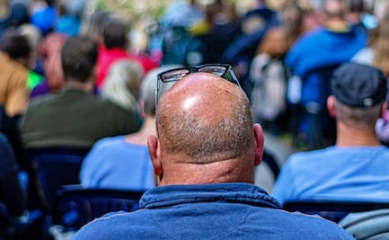 ¿Los calvos tienen mayor riesgo de agravar síntomas por coronavirus?