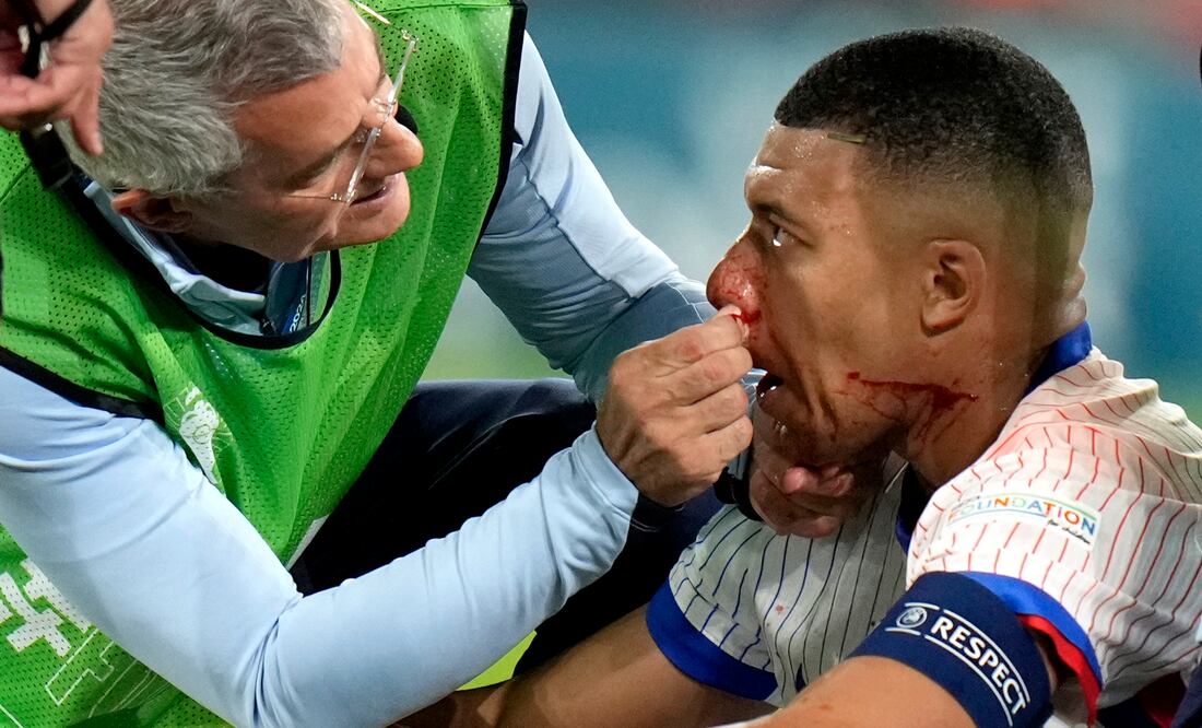 Mbappé fracturado: El impactante choque que lo deja fuera del partido Austria-Francia en la Eurocopa. (AP Photo/Alessandra Tarantino)