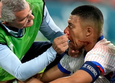 Mbappé fracturado: El impactante choque que lo deja fuera del partido Austria-Francia en la Eurocopa