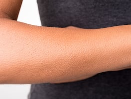 ¿Por qué se nos 'pone la piel de gallina' y cuándo se convierte en un problema?