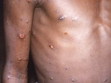 Viruela del mono. ¿Existe tratamiento? ¿Cómo se cura?